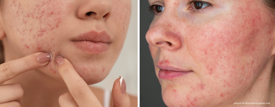 Rosacea and Acne